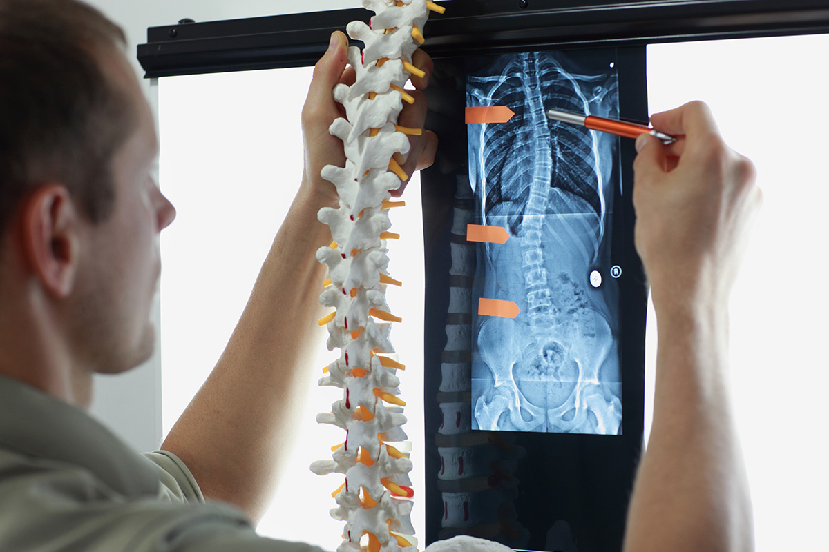 Read more about the article What is Scoliosis?