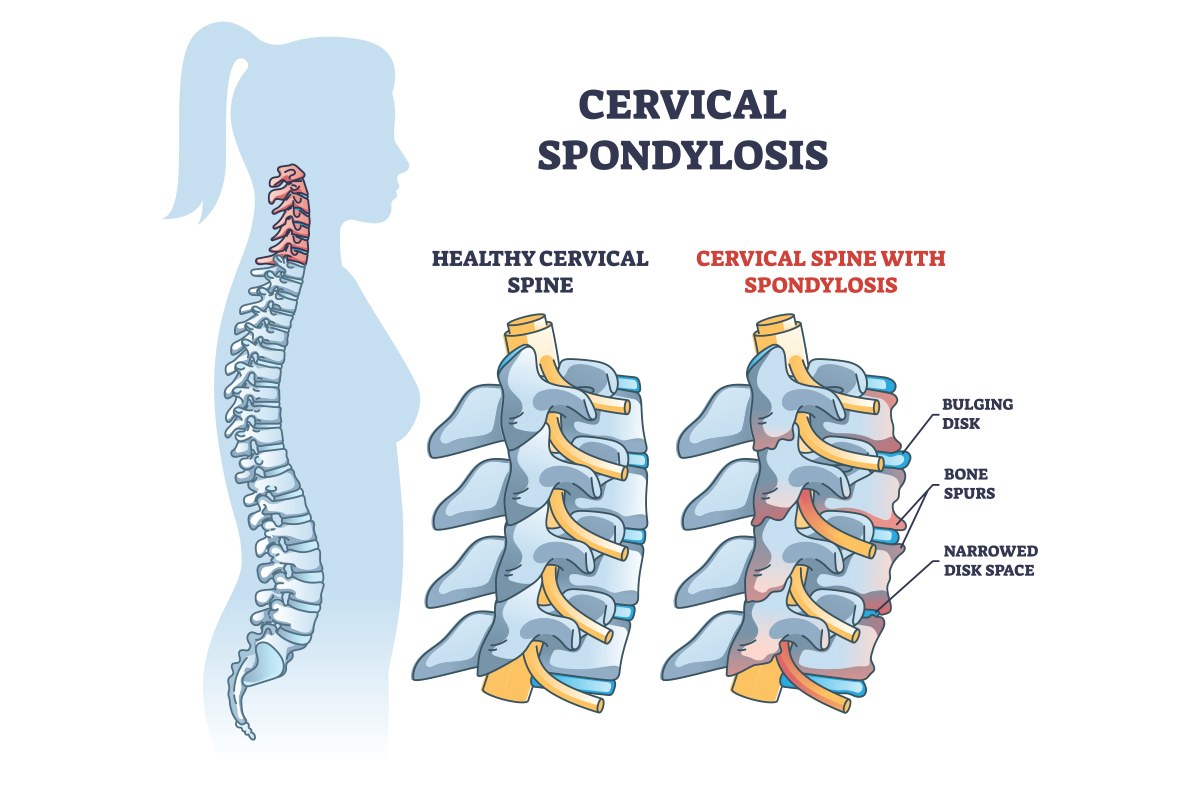 Read more about the article Spondylosis